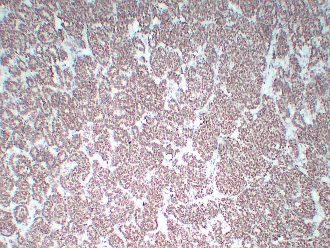 WT1 / Wilms Tumor 1 Antibody (clone ABT-WT1)