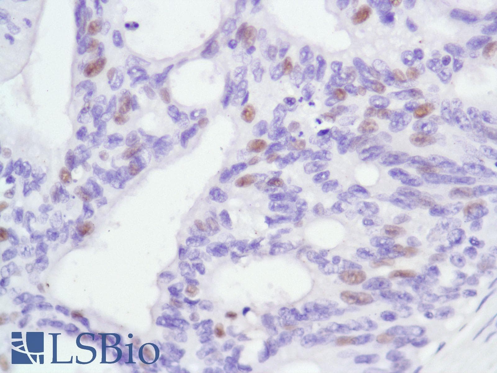 Monoclonal Rabbit anti-Human AR / Androgen Receptor Antibody (clone SP107, N-Terminus, IHC)
