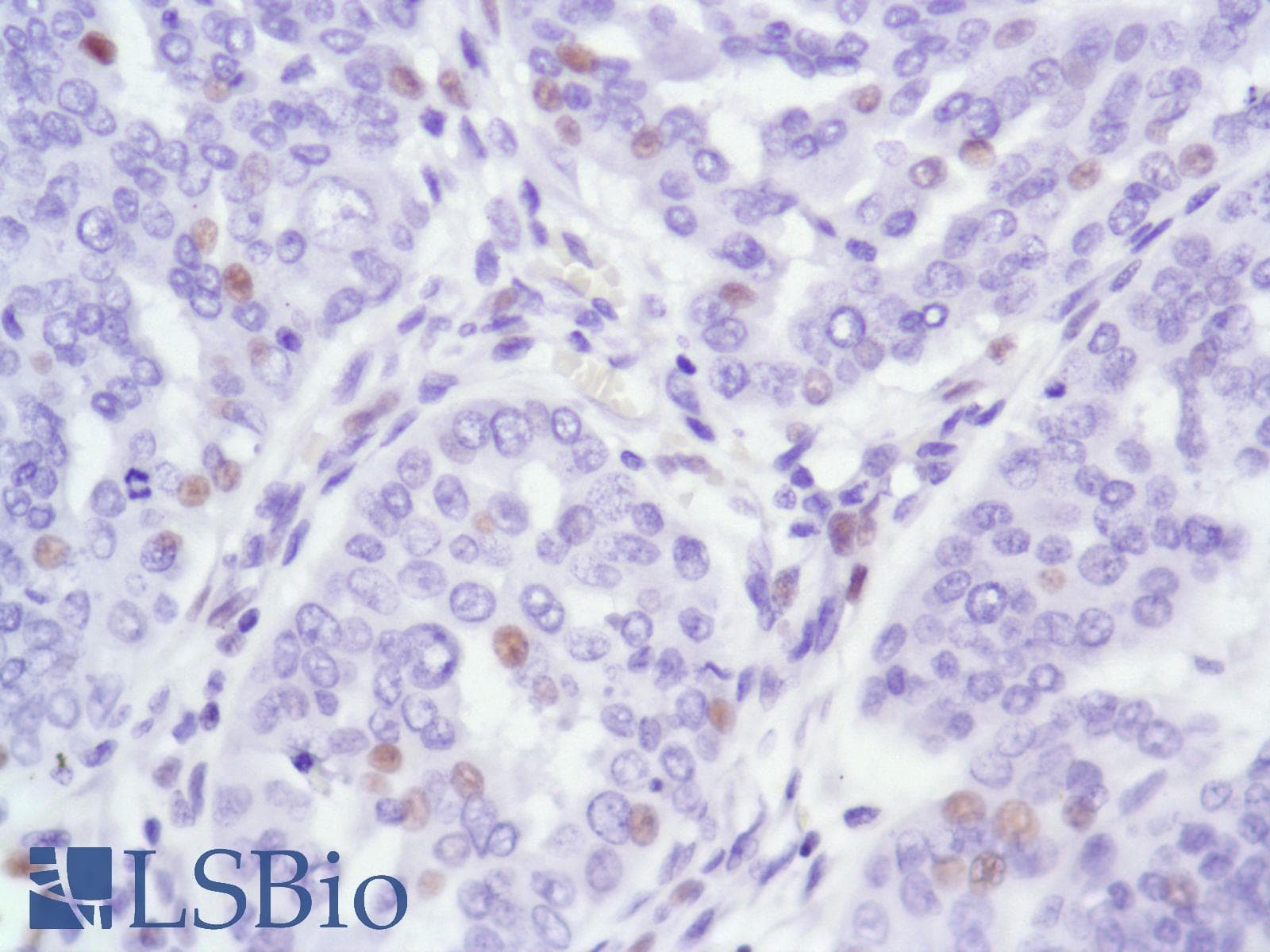 Monoclonal Rabbit anti-Human AR / Androgen Receptor Antibody (clone SP107, N-Terminus, IHC)