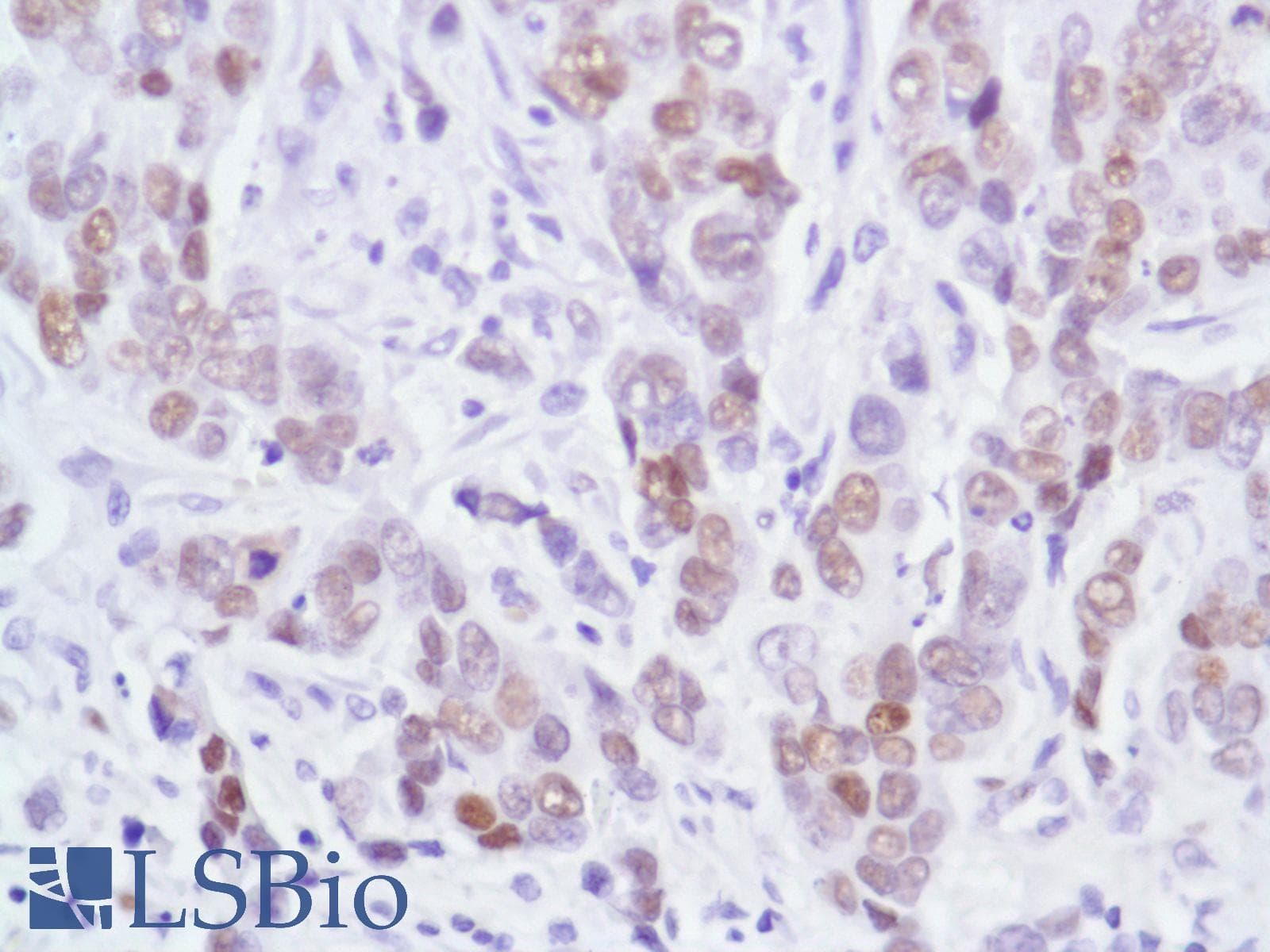 Monoclonal Rabbit anti-Human AR / Androgen Receptor Antibody (clone SP107, N-Terminus, IHC)