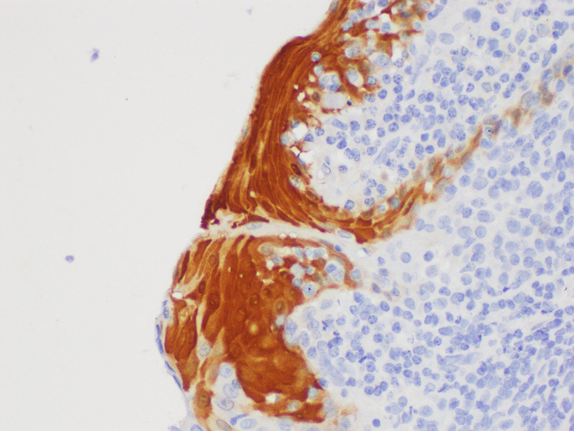 Polyclonal Rabbit anti-Human S100A7 / Psoriasin Antibody (IHC)