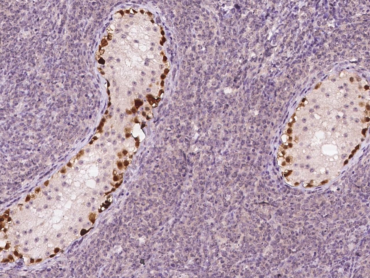 Polyclonal Rabbit anti-Human SSX2 Antibody (IHC)