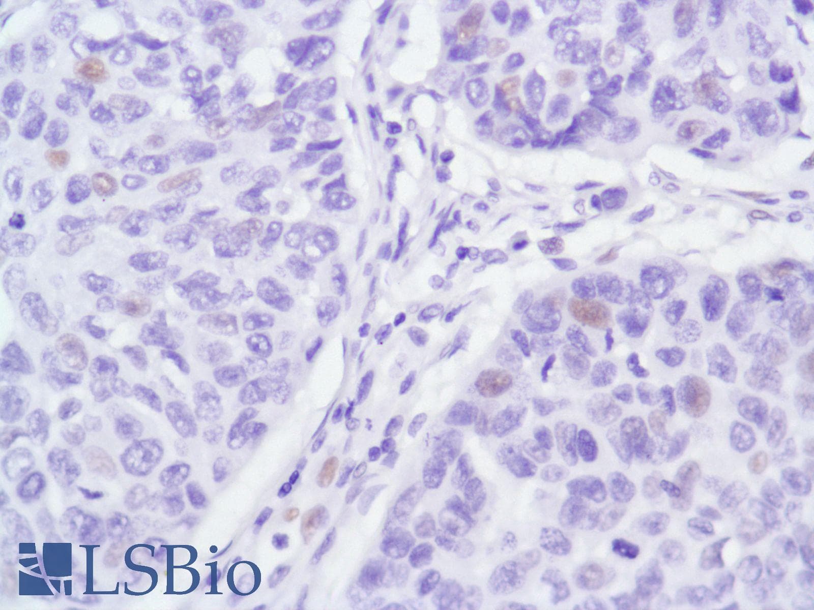 Monoclonal Rabbit anti-Human AR / Androgen Receptor Antibody (clone SP107, N-Terminus, IHC)