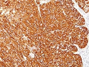 Melanoma Antibody (clone M2-7C10 + M2-9E3 + HMB45 + T311)