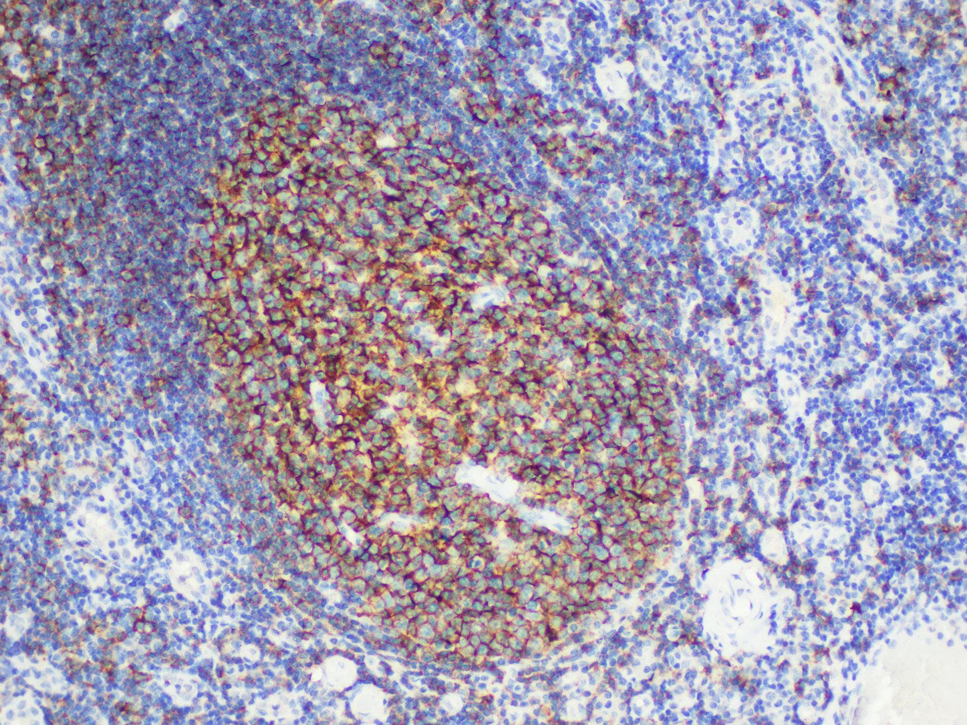 CD20 Antibody