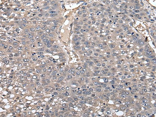 Polyclonal Rabbit anti-Human N-acetyllactosaminide beta-1,6-N-acetylglucosaminyl-transferase, isoform C Antibody (IHC)