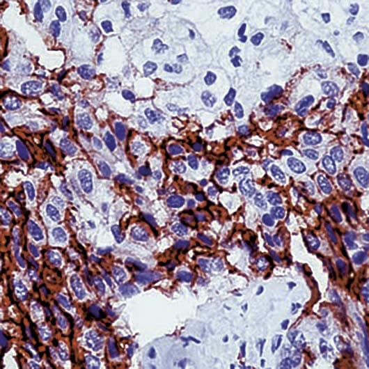 PathPlus™ Mesothelioma Antibody (clone HBME-1)