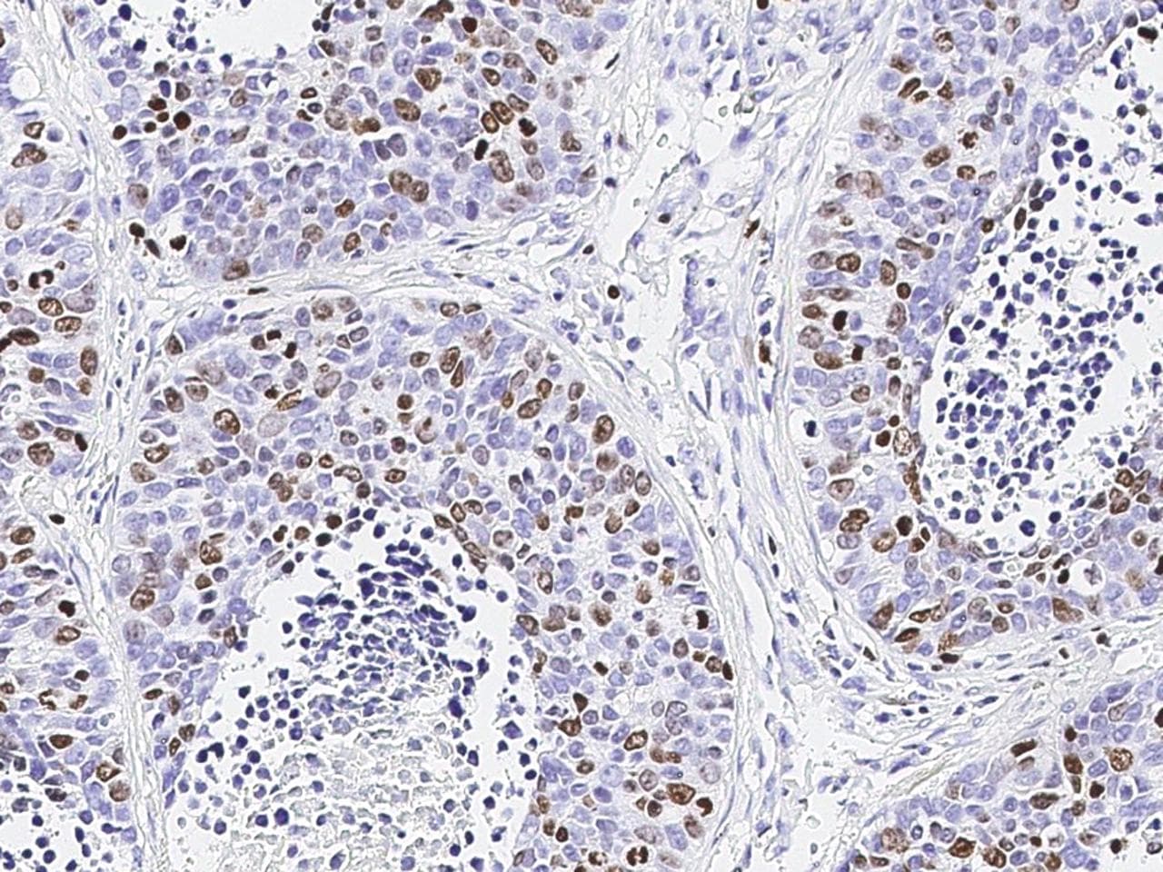 Monoclonal Mouse anti-Human MKI67 / Ki67 Antibody (clone 21, Preservative Free, IHC)