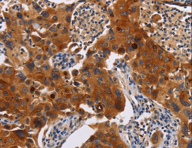 Polyclonal Rabbit anti-Human MSLN / Mesothelin Antibody (IHC)