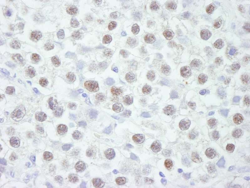 Polyclonal Rabbit anti-Human CHEK2 / CHK2 Antibody (aa475-525, IHC)