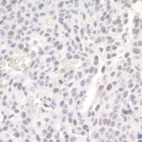 Polyclonal Rabbit anti-Human ZEB1 / AREB6 Antibody (aa1074-1124, IHC)
