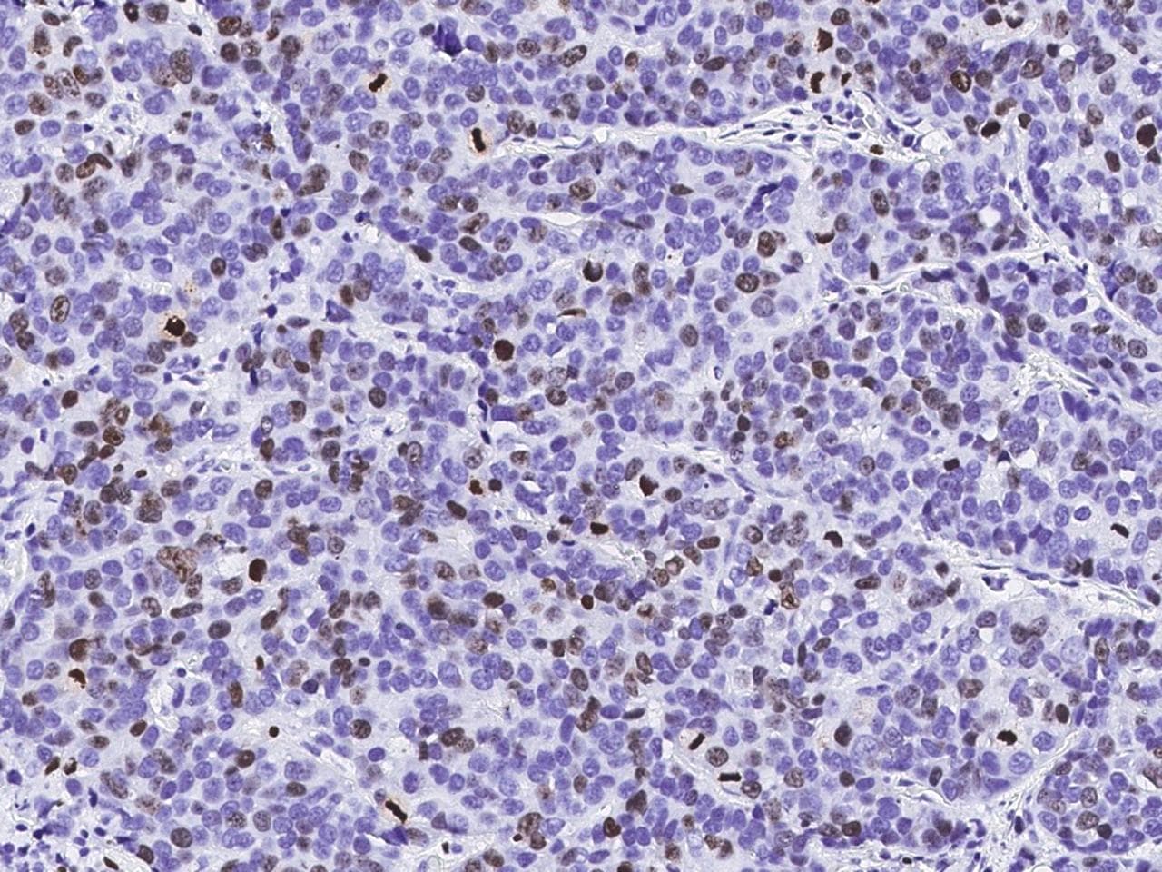 Monoclonal Mouse anti-Human MKI67 / Ki67 Antibody (clone 21, Preservative Free, IHC)