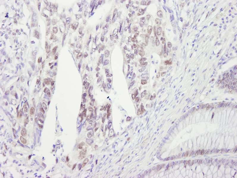 Polyclonal Rabbit anti-Human CHEK2 / CHK2 Antibody (aa475-525, IHC)