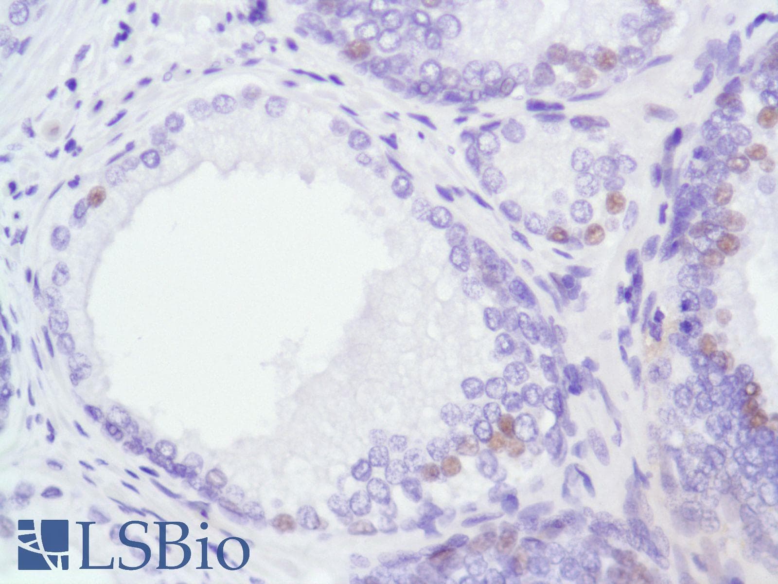 Monoclonal Rabbit anti-Human AR / Androgen Receptor Antibody (clone SP107, N-Terminus, IHC)