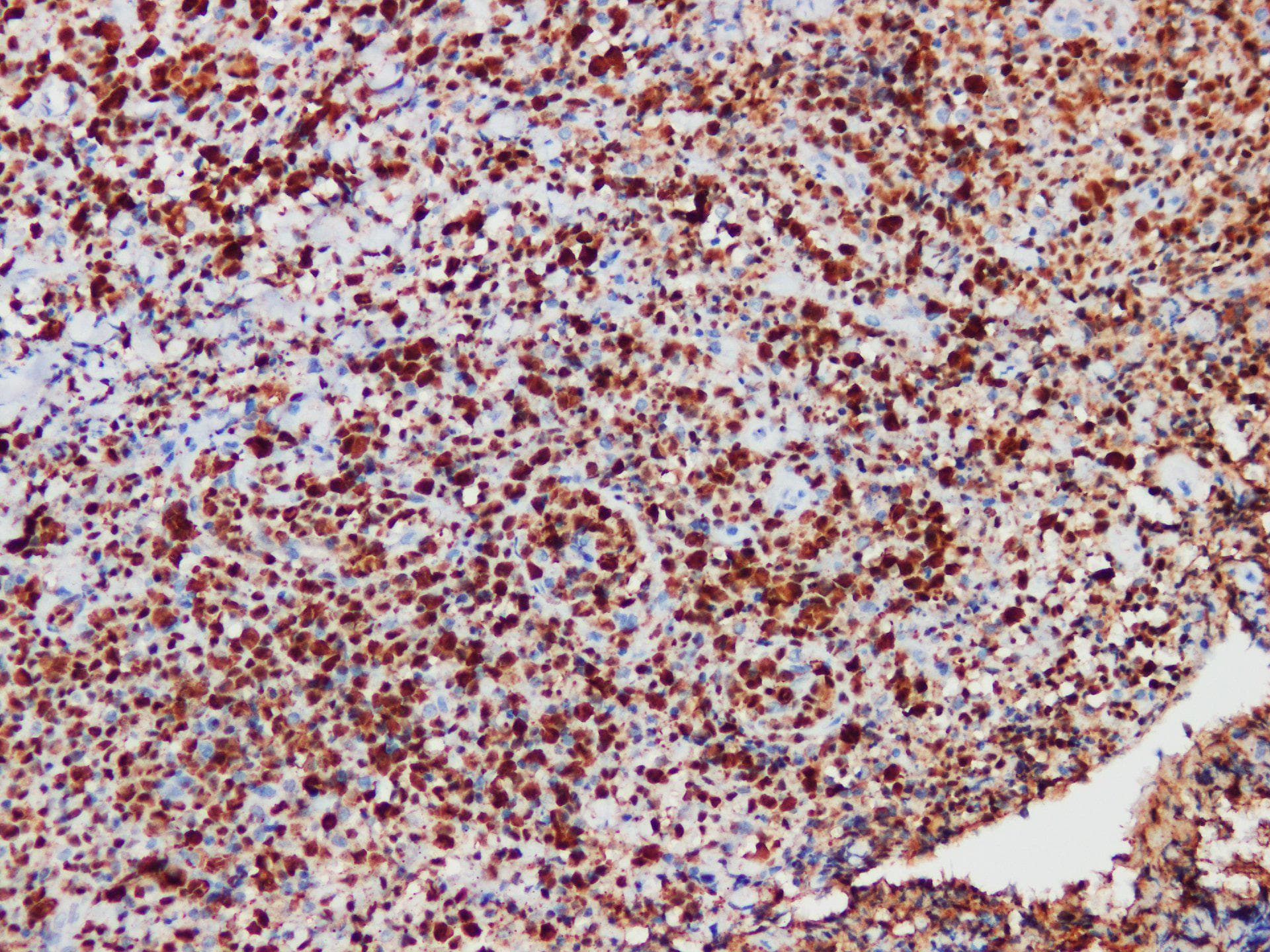 ALK / p80 Hybrid Antibody