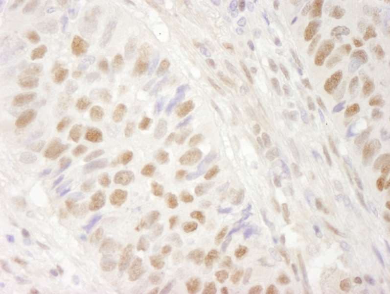 Polyclonal Rabbit anti-Human SMARCA4 / BRG1 Antibody (aa75-125, IHC)