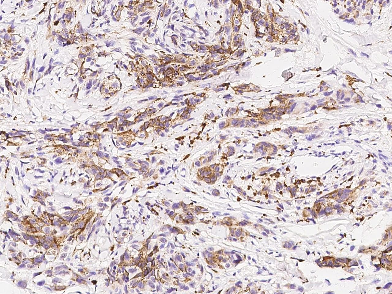 Polyclonal Rabbit anti-Human PMEL / SILV / gp100 Antibody (IHC)
